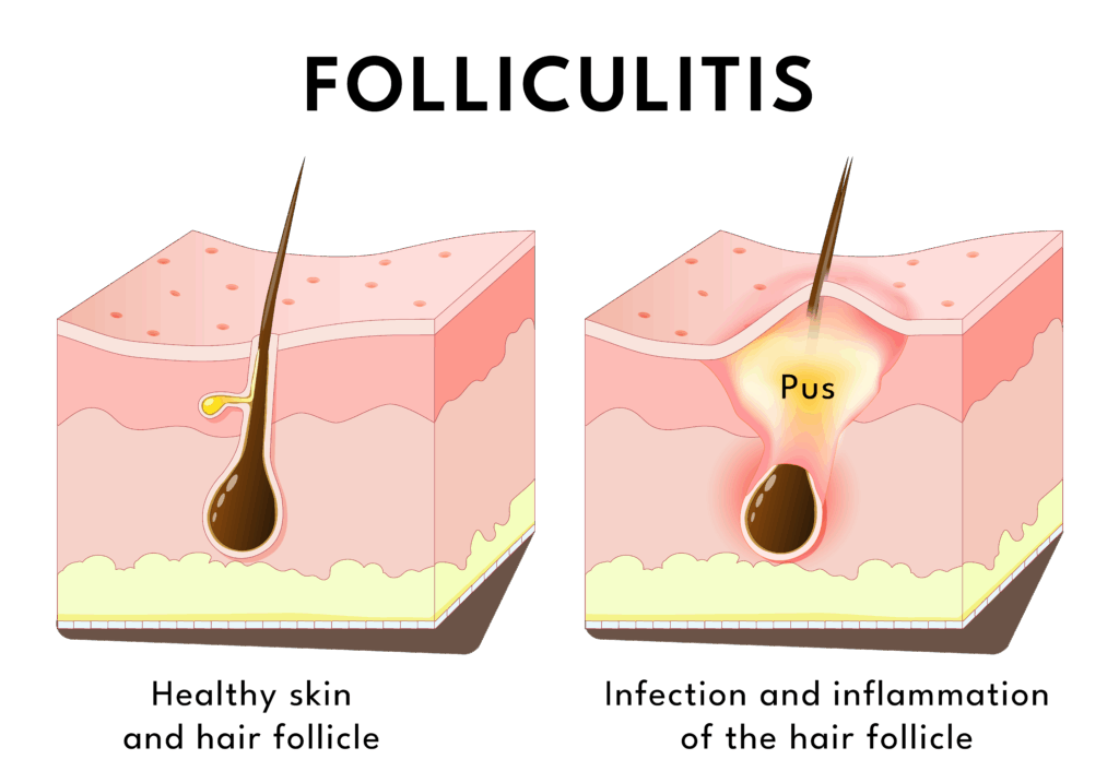 folliculitis