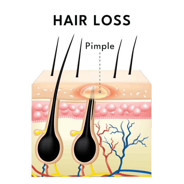 hair loss