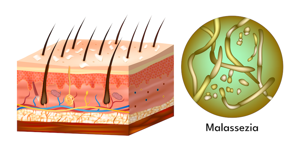 malassezia