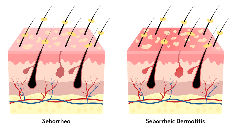 seborrhea and seborrheic dermatitis