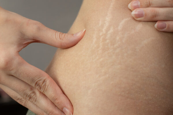 young woman showing stretch marks on her body.