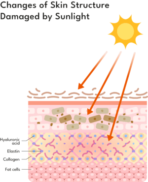 changes of skin structure damaged by sunlight before