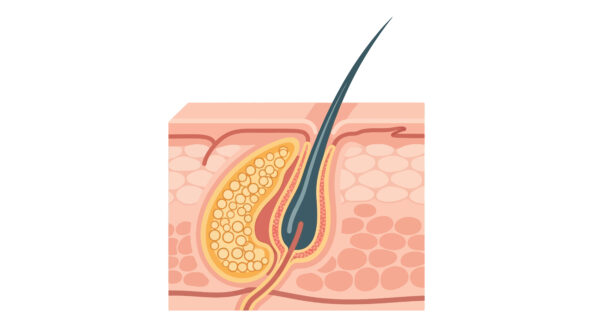 medical illustration showing human skin layers, hair follicle, and sebaceous gland structure.