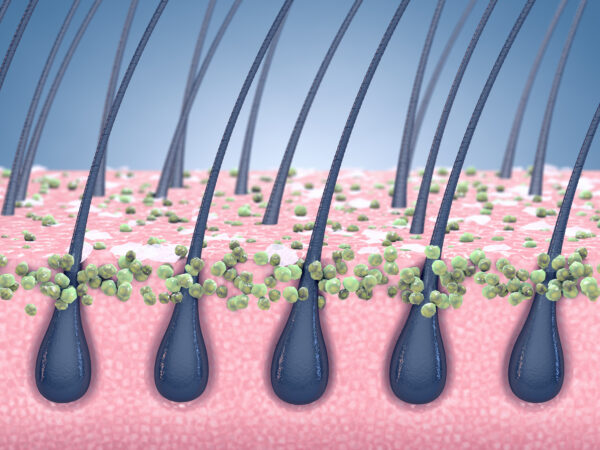 dandruff prevention and antifungal treatment, human scalp hair roots and fungal infection